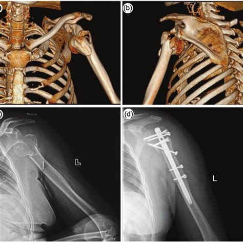 Recovery As Shown By Computed Tomography Scans And X Ray Images Of A