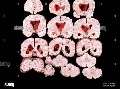 Patología macroscópica que muestra cortes cerebrales de todo el cerebro