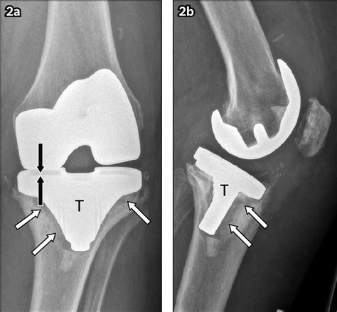 A Anteroposterior And B Lateral Left Knee Radiographs In A Download Scientific Diagram