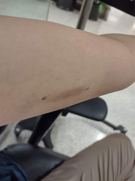 Nexplanon 5 days after insertion! Surprisingly very little bruising and