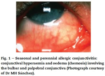 Seasonal Allergic Conjunctivitis