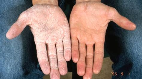 Queratodermia Palmoplantar Hiperqueratosis Palmaris Et Plantaris