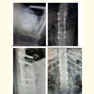 A B Immediate Post Operative AP And Lateral X Rays After Posterior