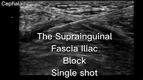 The Suprainguinal Fascia Iliac Block In The Emergency Department Youtube