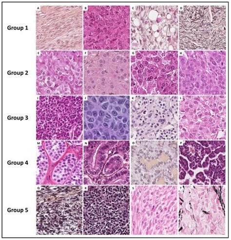 Molecular Pathology For Sex Cordstromal Tumors Of Ovary Encyclopedia