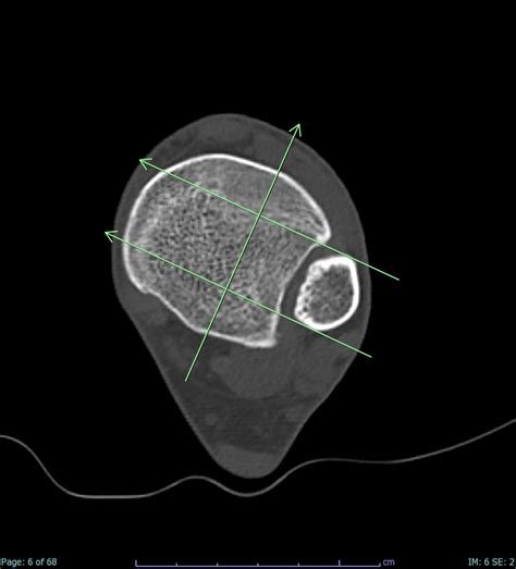 Ct Msk With C Sphp Radiology Protocols