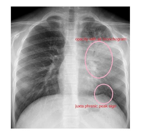 Imaging Case Of The Week 336 Answer Emergucate