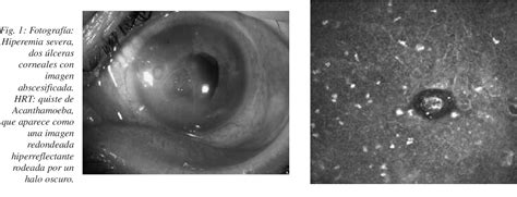 Figure 1 From Aplicación De La Microscopía Confocal Hrt En El Diagnóstico De Las Queratitis