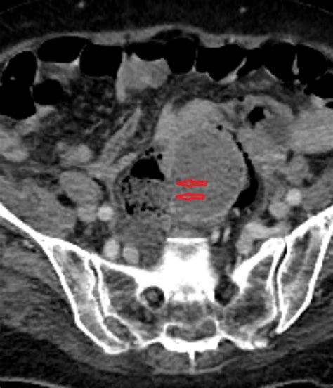 Stercoral Perforation Sigmoid Colon Image