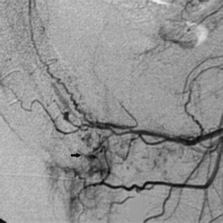 Selective Right Pudendal Arteriogram Cavernous Blush Disappeared After