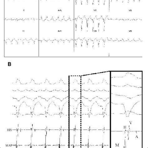 Mahaim Antidromic Tachycardia A 12 Lead Electrocardiographic Tracing Download Scientific