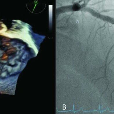 Preoperative Three Dimensional View Of The Mitral Valve Prolapse