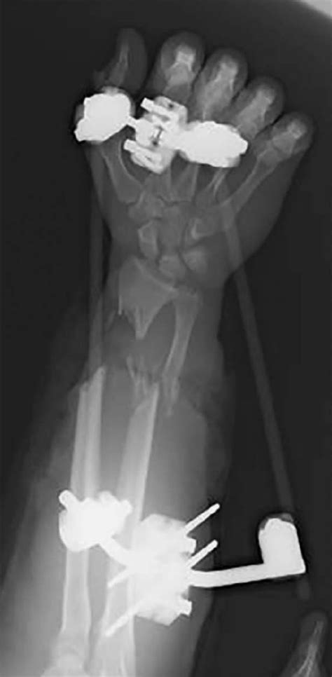 Radius And Ulnar Shaft Fractures Trauma Orthobullets