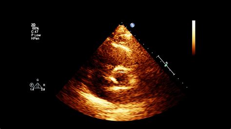 Hole in heart treatment options