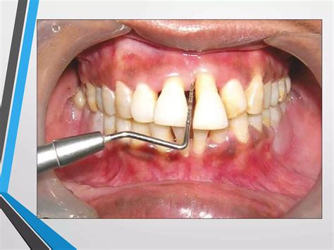 Periodontal Pocket And Cal Ppt