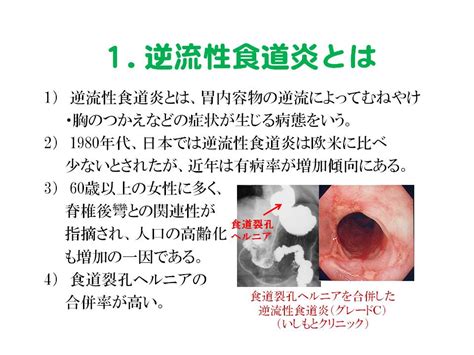 胃・食道の病気 逆流性食道炎 内科・肛門科・消化器科・外科 いしもとクリニック