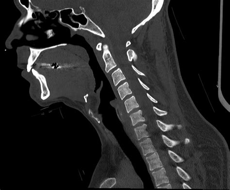 Best Cervical Spine Ct Scan Center Near Me Nanded City Pune