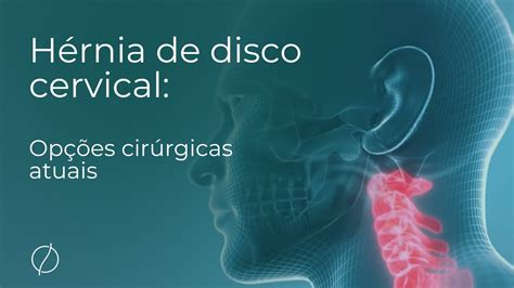 H Rnia De Disco Cervical Op Es Cir Rgicas Atuais Youtube