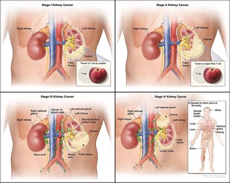 Kidney Cancer | Rocky Mountain Cancer Centers