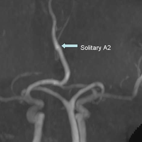 Mricases Azgos Anterior Cerebral Artery