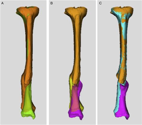 Preoperative 3 Dimensional 3 D Planning Of Single Cut Osteotomy Of Download Scientific