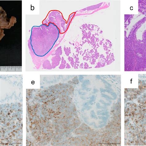 Macroscopic And Microscopic Findings On Examination Of The Resected