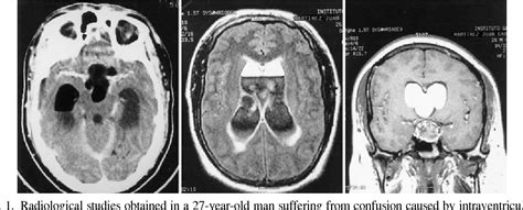 Figure 1 From Massive Rupture Of Suprasellar Dermoid Cyst Into