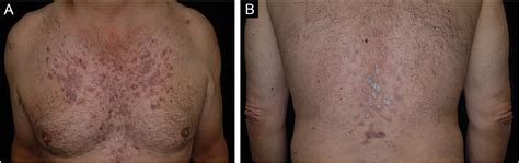 SciELO Brasil Lichenoid Drug Eruption Induced By Pravastatin It Is