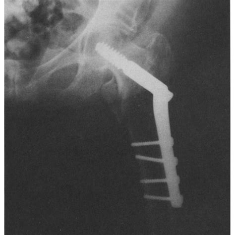 Anteroposterior Radiograph Demonstrating Implant And Fracture Fragment