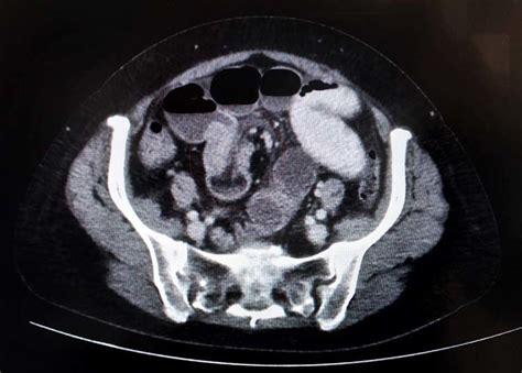 Axial Section Of Abdominal Ct Scan Showing Bowel Within Bowel