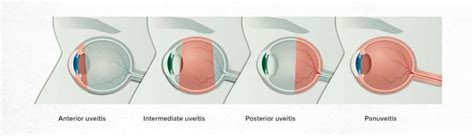 Uveitis Penyebab Jenis Gejala Komplikasi Pengobatan