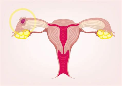 Ectopic Pregnancy Vector Images Depositphotos