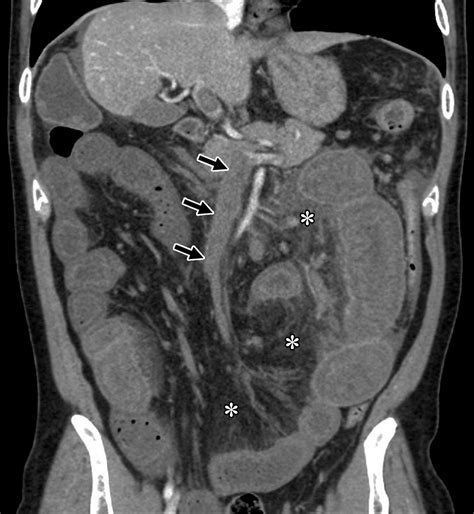 Acute Mesenteric Ischemia Multidetector Ct Findings And Endovascular