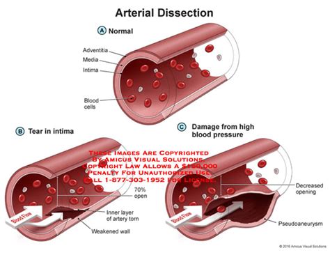 Amicus Illustration Of Amicusmedicalarterialdissectionadventitia