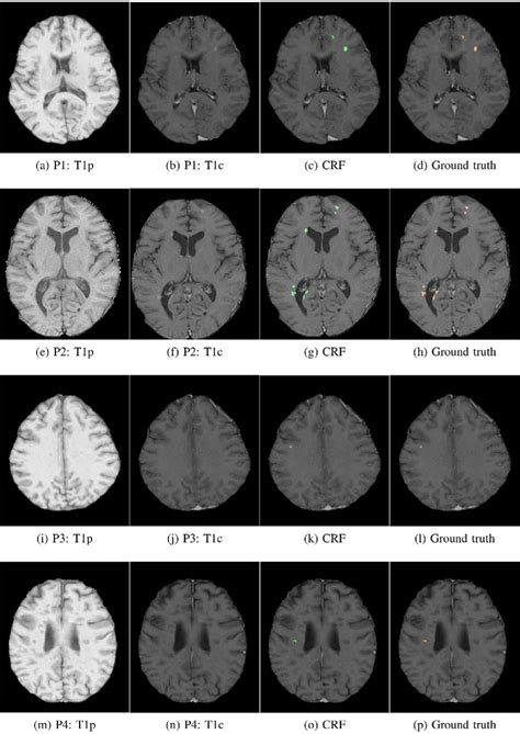 Figure 3 From Automatic Detection Of Gadolinium Enhancing Multiple Sclerosis Lesions In Brain