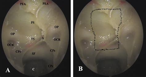 Extended Endoscopic Endonasal Transsphenoidal Approach To The