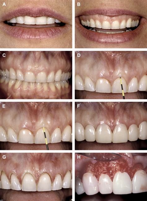 A Multidisciplinary Approach To Esthetic Dentistry Pocket Dentistry