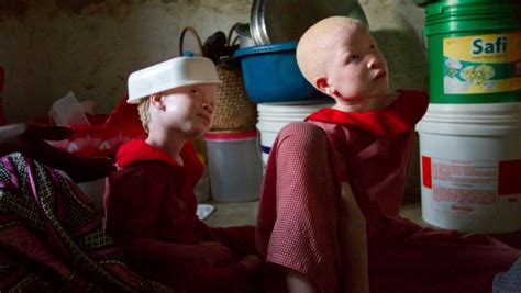 For Tanzania’s Albinos Superstition Leads To Violence The World From Prx