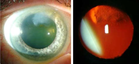 Salzmann's Nodular Corneal Degeneration: The University of Iowa ...