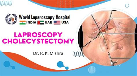 Laparoscopic Cholecystectomy Video