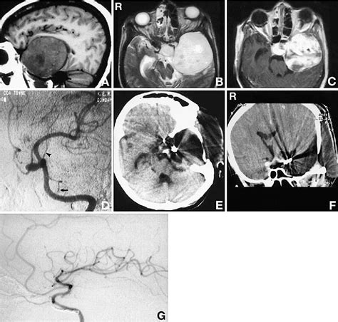 Figure From Extradural Approach For Cavernous Hemangioma Of The