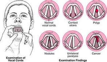 Symptoms and Causes - Vocal Nodules