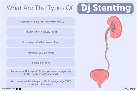 Dj Stenting Causes Symptoms Treatment And Cost