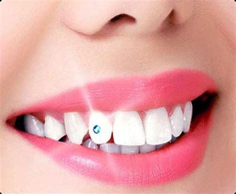 Tooth Whitening Sk Smile Dental Clinic