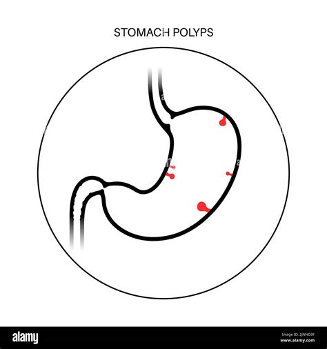 Gastric Polyp Cut Out Stock Images And Pictures Alamy