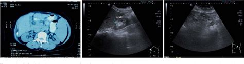 Figure 1 From Polycythemia Vera Concomitant With Renal Angiomyolipoma