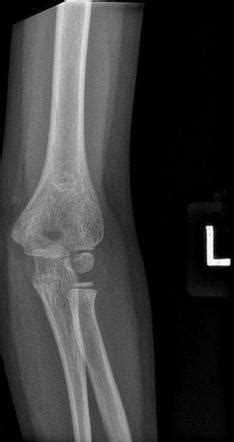 Paediatric Elbow Ap View Radiology Reference Article Radiopaedia Org