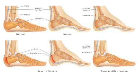 Боль в пятке у детей Пяточный апофизит Severs disease