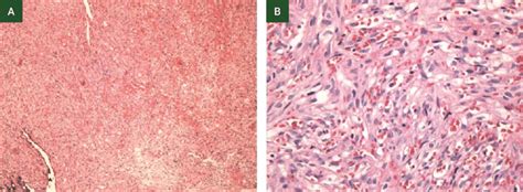 Low A 100x And High B 400x Power Microscopic View Of Oral Kaposis