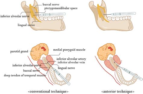 Figure From Local Anesthesia For Mandibular Third Molar Extraction